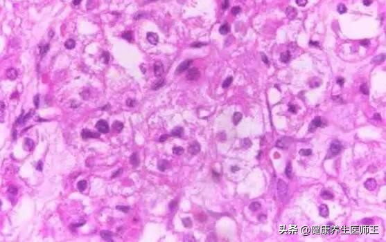 外阴良性肿瘤的症状,外阴良性肿瘤暂时不做手术可以吗