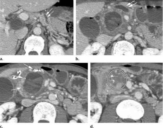 胰腺炎的影像学诊断与鉴别,胰腺炎与胰腺癌的鉴别表格
