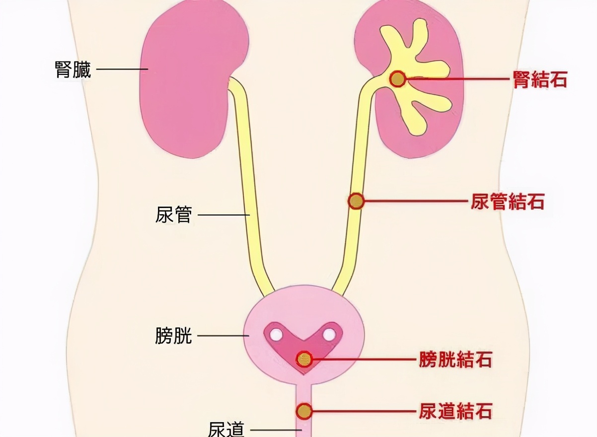 泌尿结石疼痛级别,泌尿科医生排石