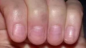 宝宝指甲月牙少有白点怎么回事,宝宝指甲出现空甲现象怎么办