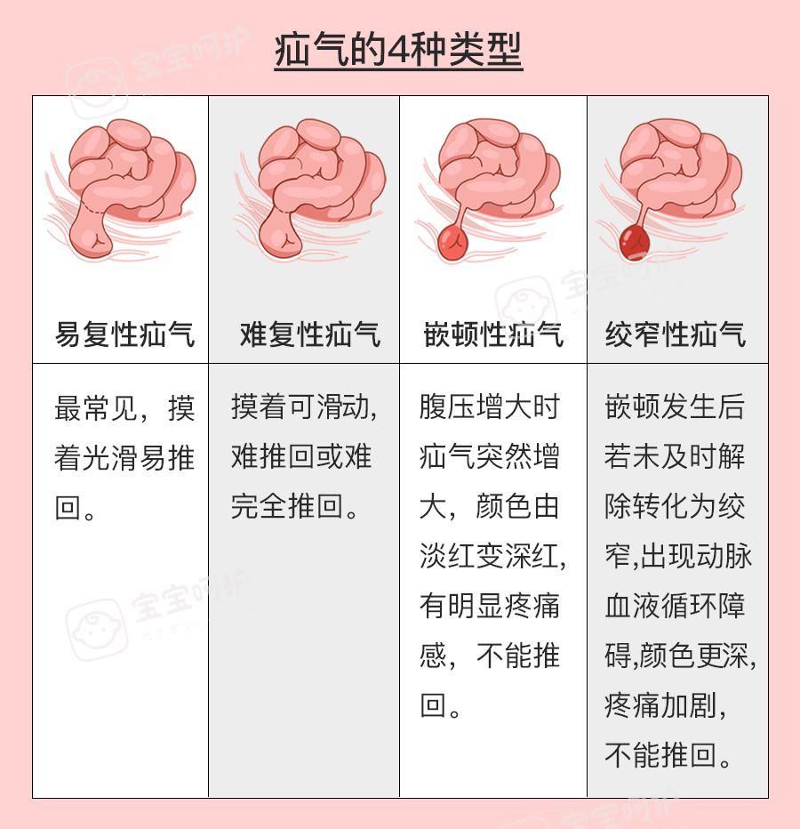 宝宝脐疝多久能自愈,脐疝长了四五年了还有可能自愈吗