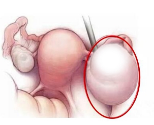 腺肌症+巧囊，这一路实在太难，后来才知道这俩可以一起解决