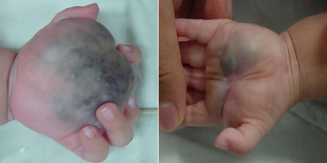 什么样的血管畸形不能打硬化剂,儿童血管畸形硬化过程