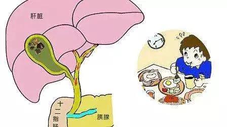 外科胆总管结石,外科胆囊结石新疗法