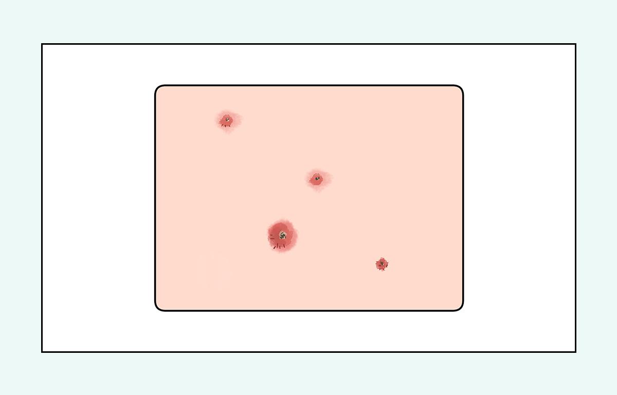 脸上的红疙瘩疼是什么原因,脸上的各种疙瘩