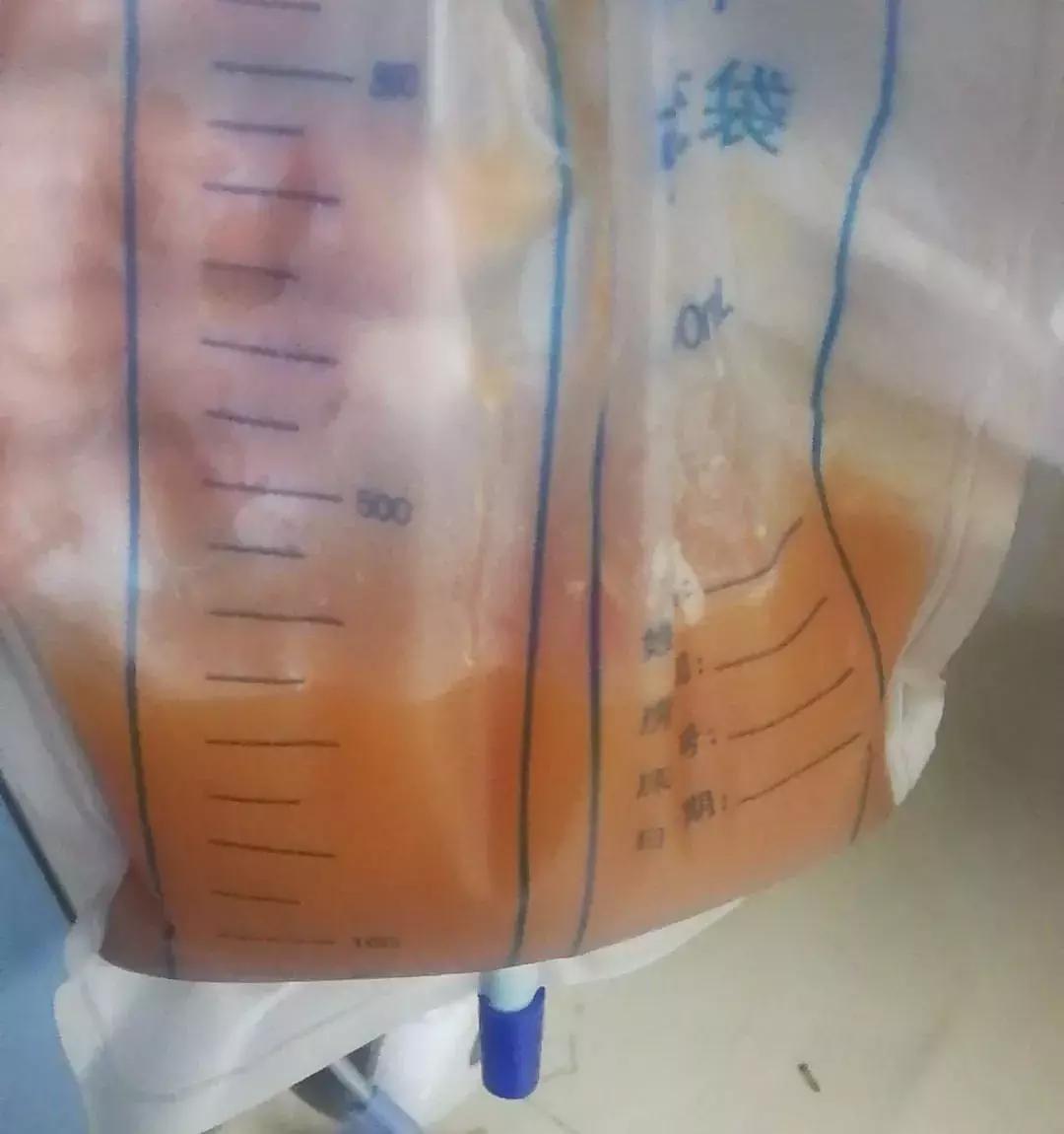 把病人的胸水当“宝贝”，医生亲自从青海护送到杭州！这么拼的吗？