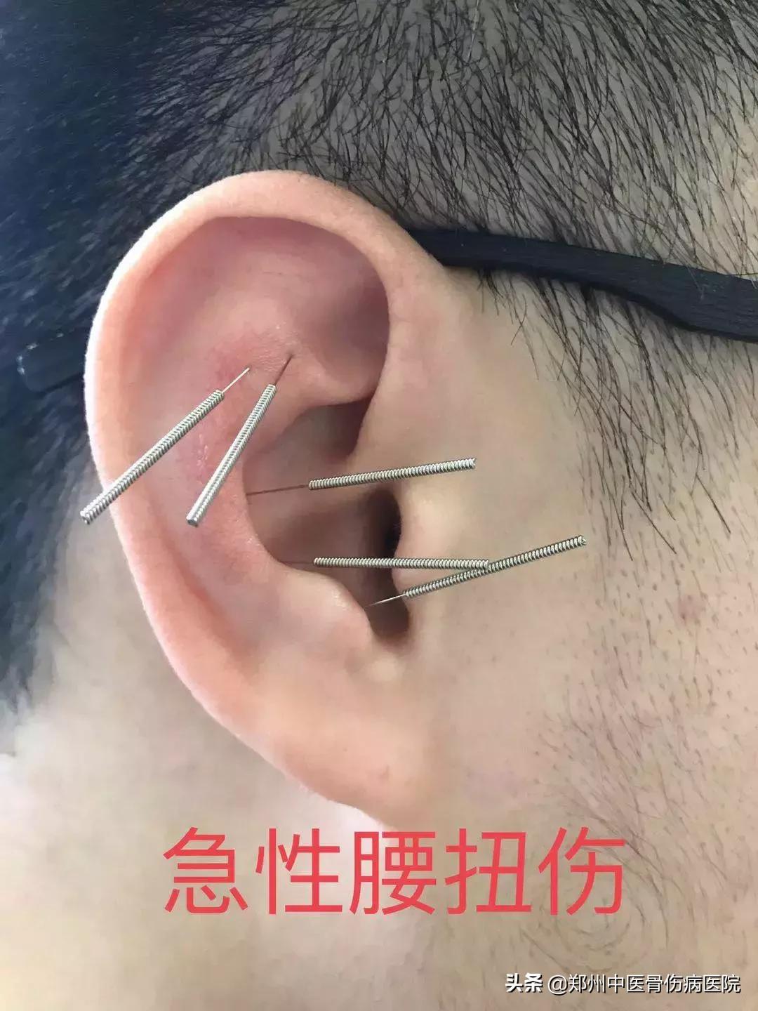 小耳朵大乾坤,耳穴的秘密中医