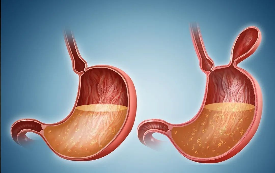 nccn指南胃癌的治疗方案,csco胃癌诊疗指南2023