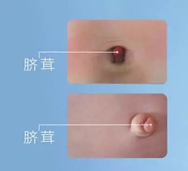 婴儿肚脐化脓新闻,出生小孩肚脐感染怎么办