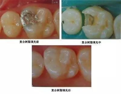 牙齿小洞不补下一句是什么,牙齿小洞不补大洞吃苦的意思