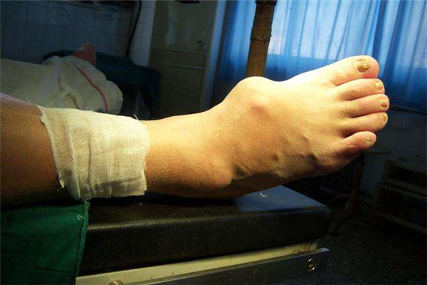 手指痛风石化脓怎么办,手指关节痛风肿流脓