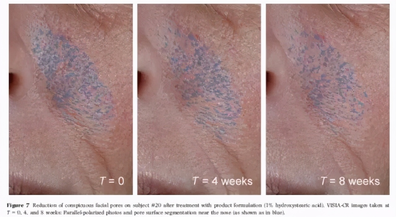 毛孔已经很大了,毛孔越来越大还长痘