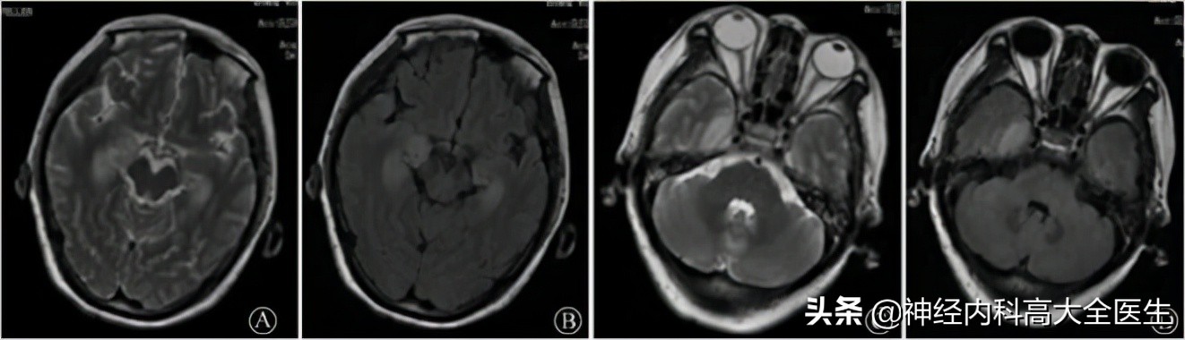 抗gaba受体脑炎临床表现轻,抗gababr抗体脑炎死亡率