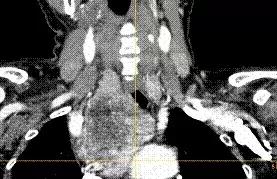 微创纵隔良性肿物切除术,微创显微技术切除肿瘤