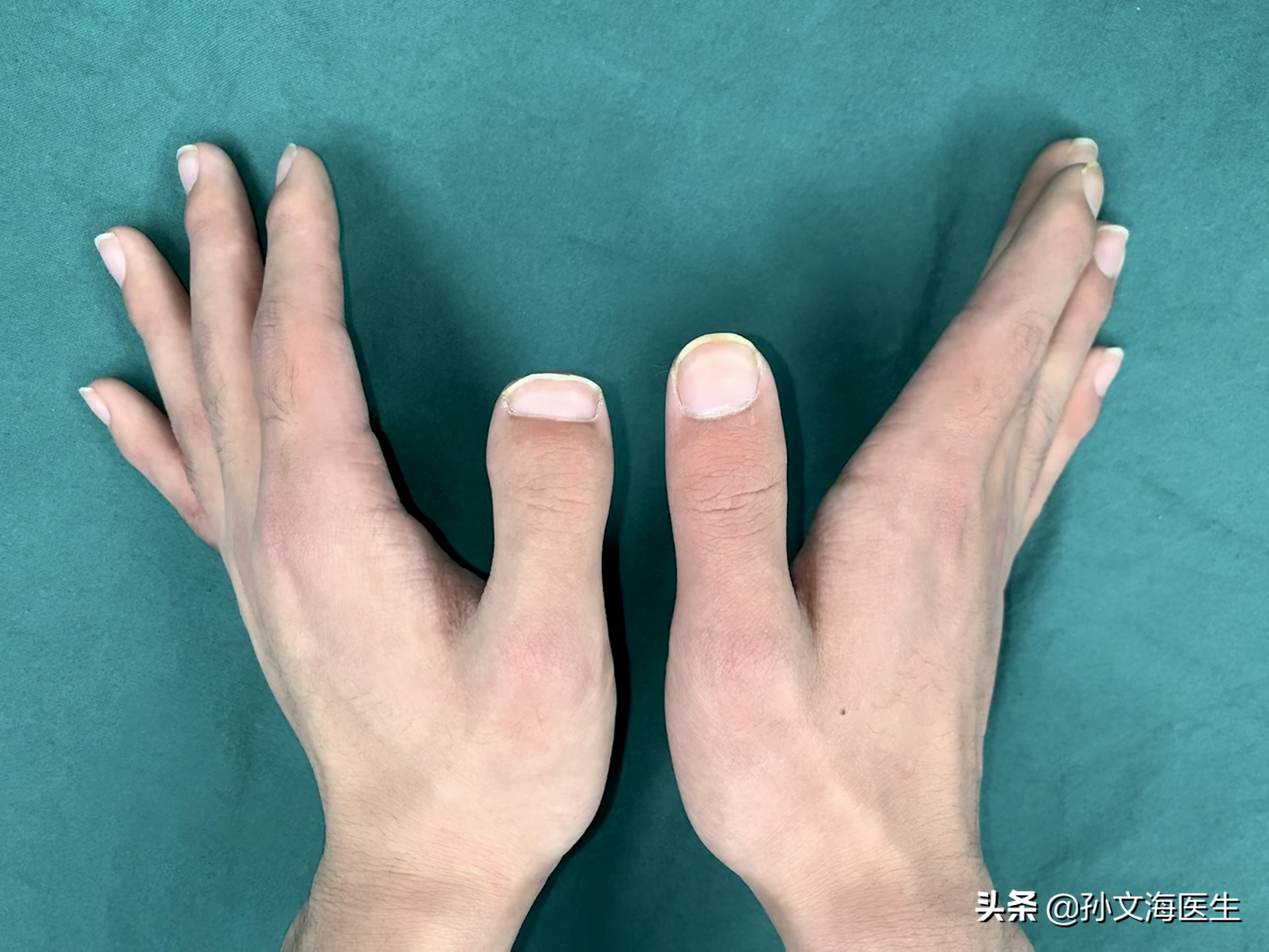 短指症大拇指矫正多少钱,大拇指短指症最佳治疗方案