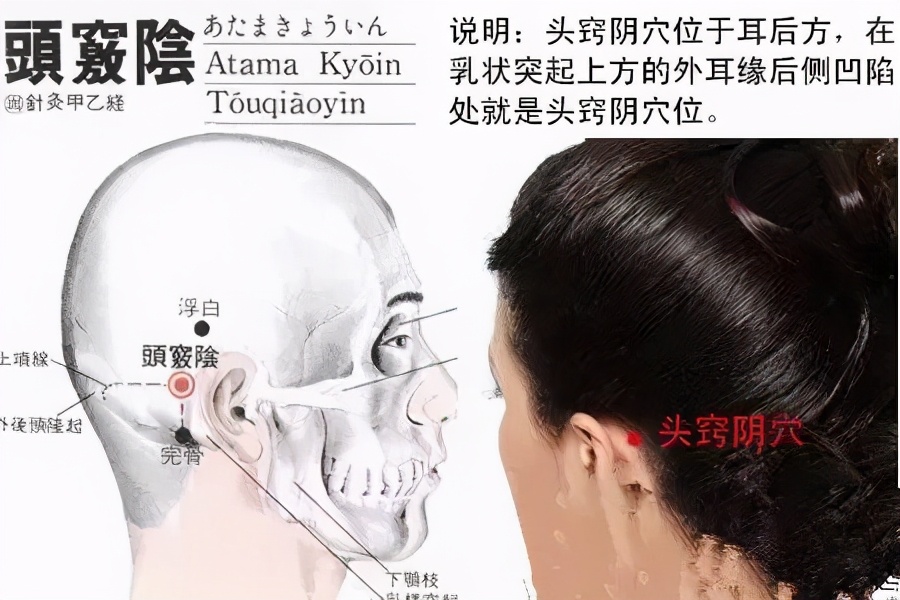 古派针灸，在欧洲治疗因痛经多次手术留下的后遗症