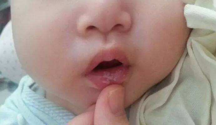 鹅口疮婴儿涂药实操,宝宝鹅口疮片