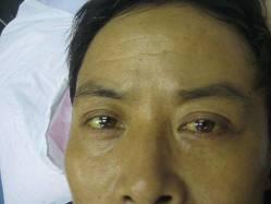 阻塞性黄疸怎么保守治疗,阻塞性黄疸凝血功能降落