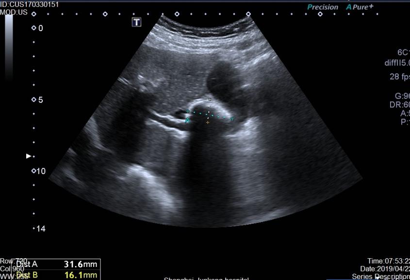 胆结石平时怎样才能把石头排出来,胆结石患者吃什么排石头