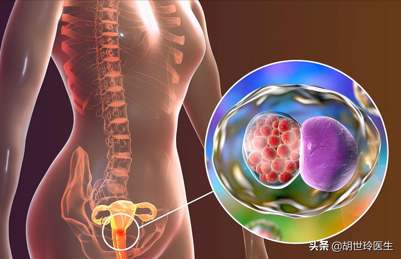 宫颈炎要怎么处理,宫颈炎需要怎么治疗