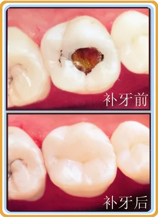 牙齿意外脱落补救方法,牙齿折断怎么判断有没有露牙神经