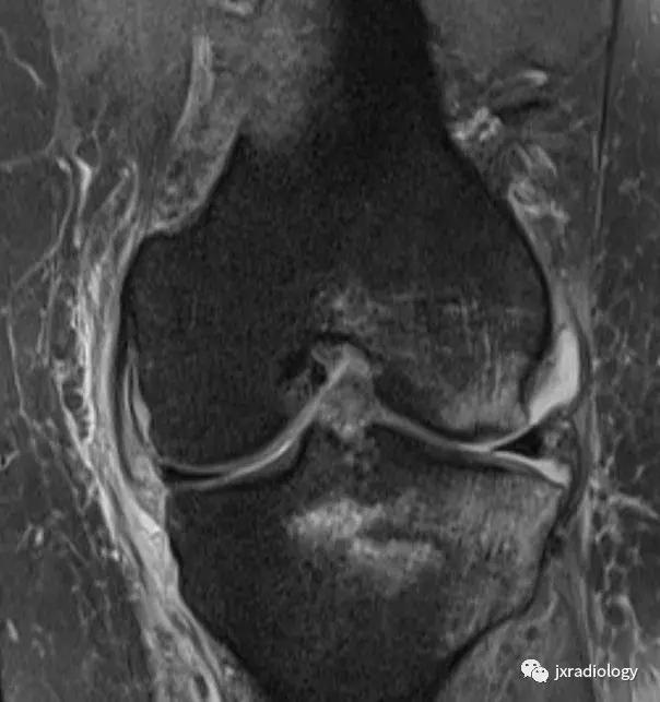 磁共振天天诊断骨髓水肿，但您知道原因吗？