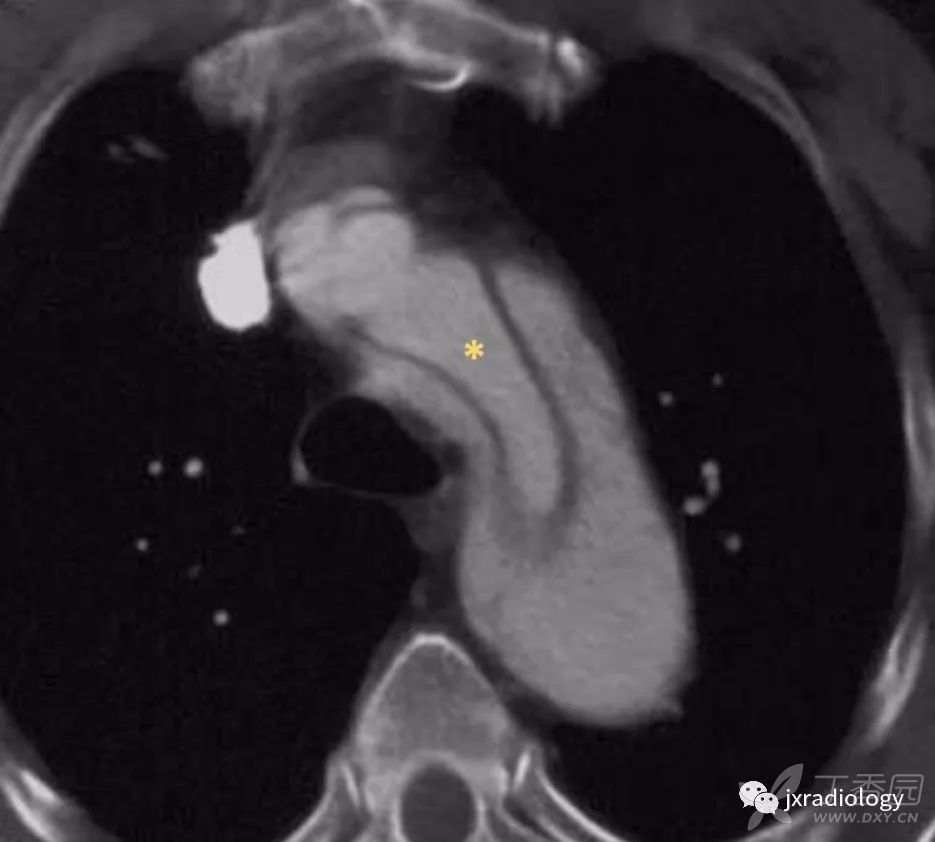 急性主动脉综合征报道,急性主动脉综合征症状