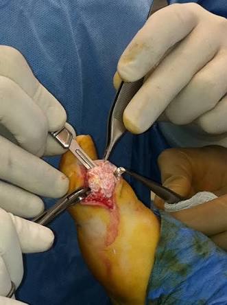 关节炎辟谣,膝关节滑膜炎辟谣