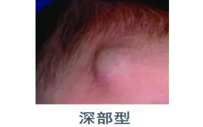 宝宝血管瘤破了应该怎么办,宝宝血管瘤破了怎么办