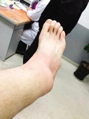 打球崴脚肿了怎么处理,打球崴脚怎么做简单处理