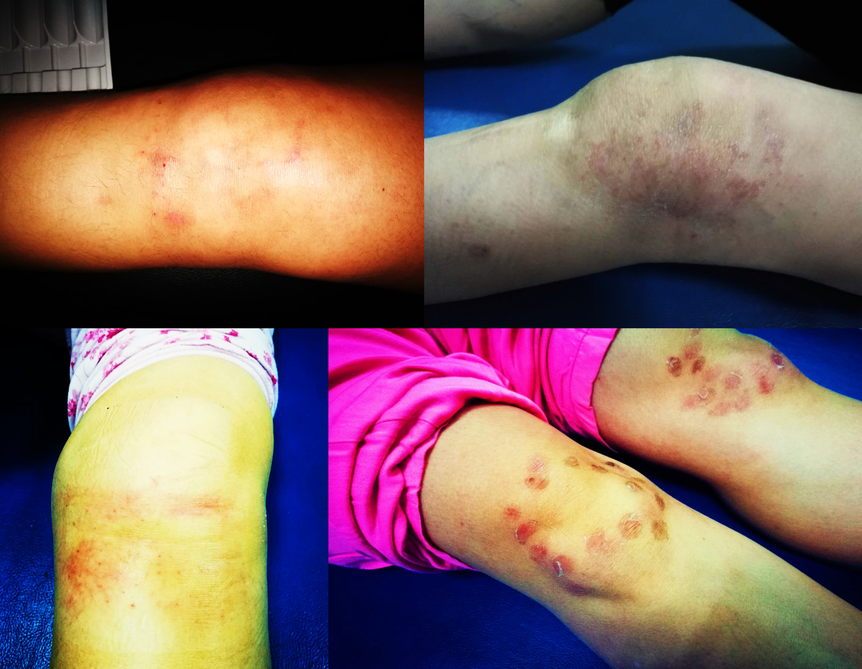 膝盖积水用烤灯能烤好吗？粗盐呢？医生：明确诊断针对治疗是关键