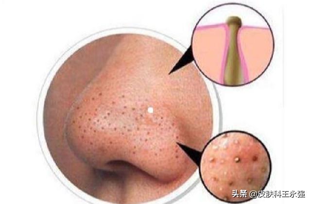 鼻子上挤出来的白条状东西是什么,鼻子可以挤出很多白色丝状物