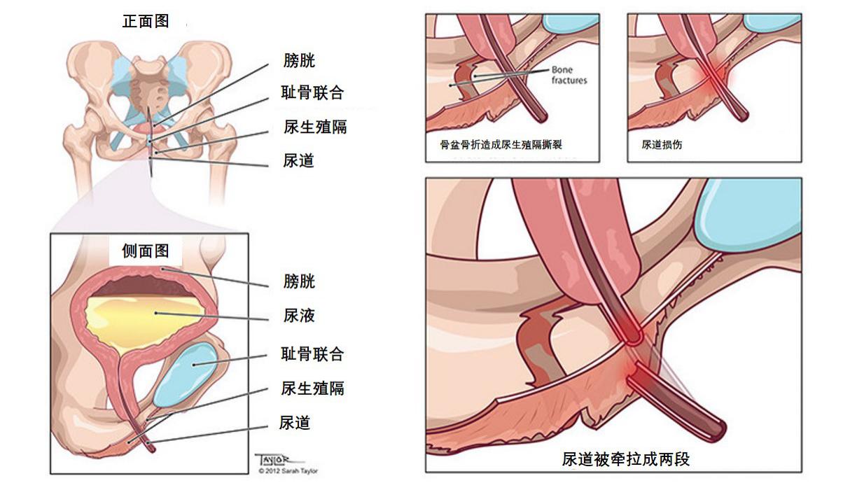 骨盆骨折后大小便出现障碍,骨盆骨折后尿道狭窄
