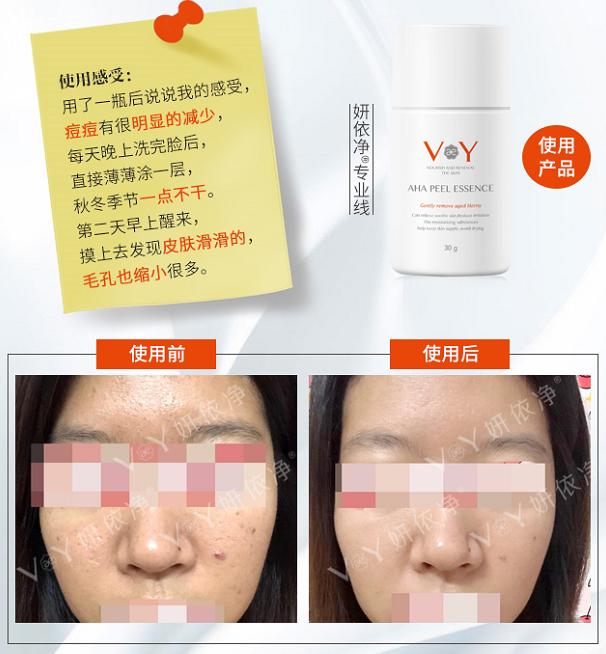 蜂胶果酸焕肤净痘精华液,全家一起用的护肤品