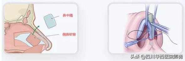 膨体鼻中隔耳软骨隆鼻后遗症,隆鼻后鼻中隔软骨突出怎么办