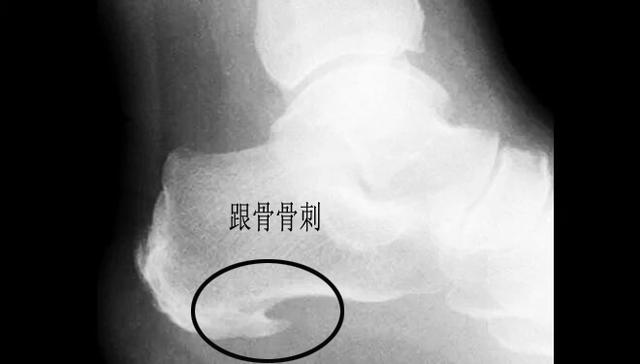 足跟疼痛教你一招百试百灵,早起落地脚疼