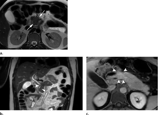 胰腺炎的影像学诊断与鉴别,胰腺炎与胰腺癌的鉴别表格