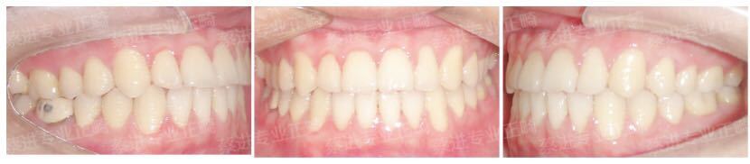 武汉大学口腔医院隐形牙齿矫正,武汉成人隐形牙齿矫正龅牙