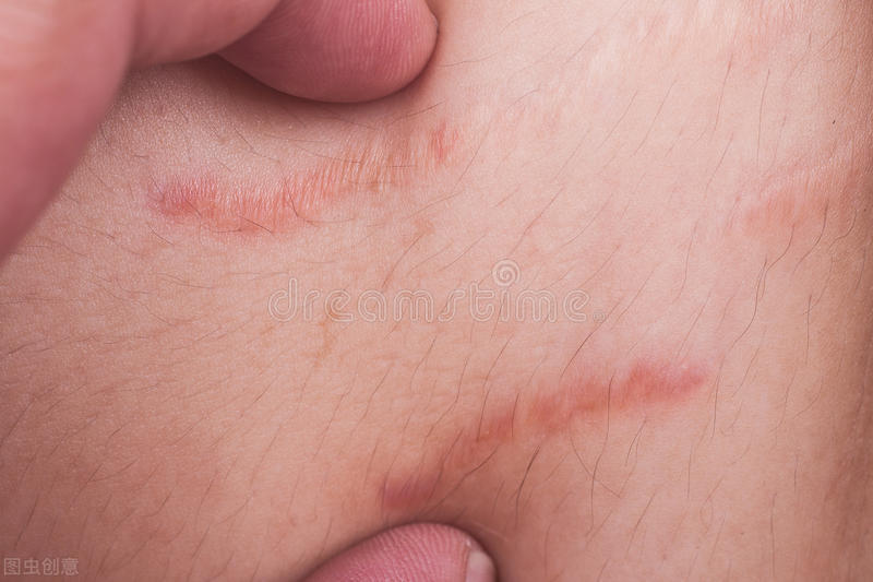 疤痕体质如何调理成不是疤痕体质,疤痕体质和不是疤痕体质区别