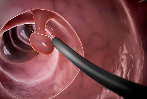 所有的息肉都会变成癌吗,所有结肠息肉都可能癌变吗