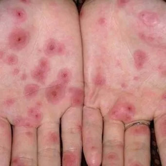 手掌脱皮偏方,手掌脱皮中医怎么治