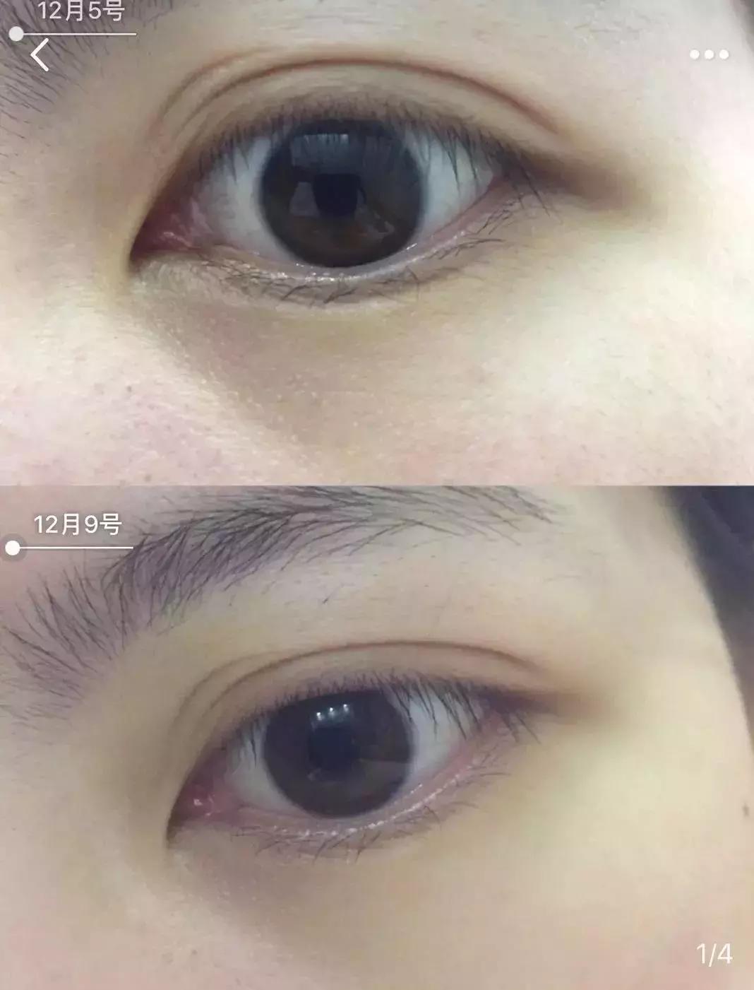 改善眼袋仅980元不开刀让你更出众,消除眼袋细纹大概多少钱