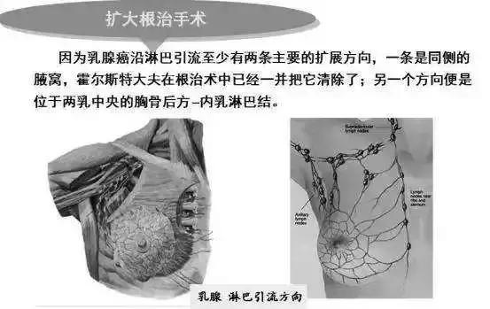 治疗乳腺癌的方法是不是都很类似,有没有治疗乳腺癌的好消息