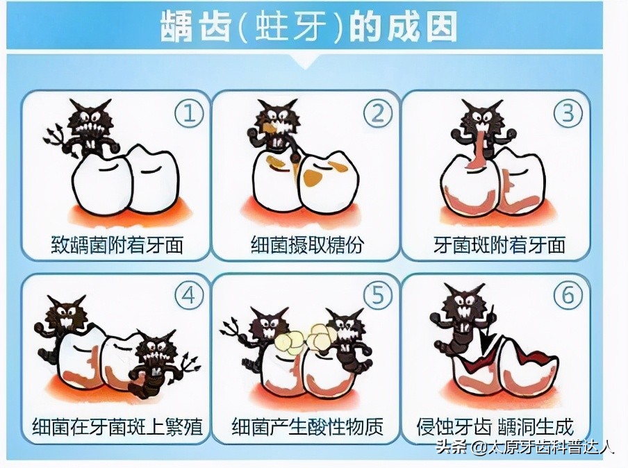 蛀牙是被虫子吃空的吗,蛀牙的虫子是什么样的