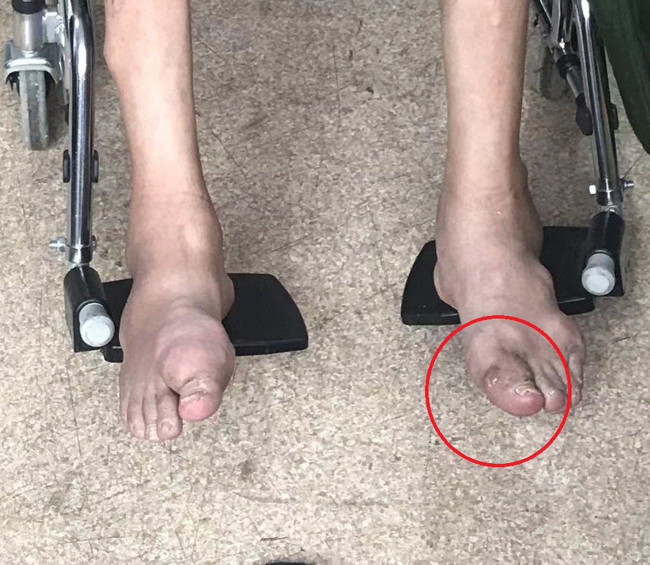 痛风石怎么溶解排出能痊愈,痛风石破溃后能自行愈合吗