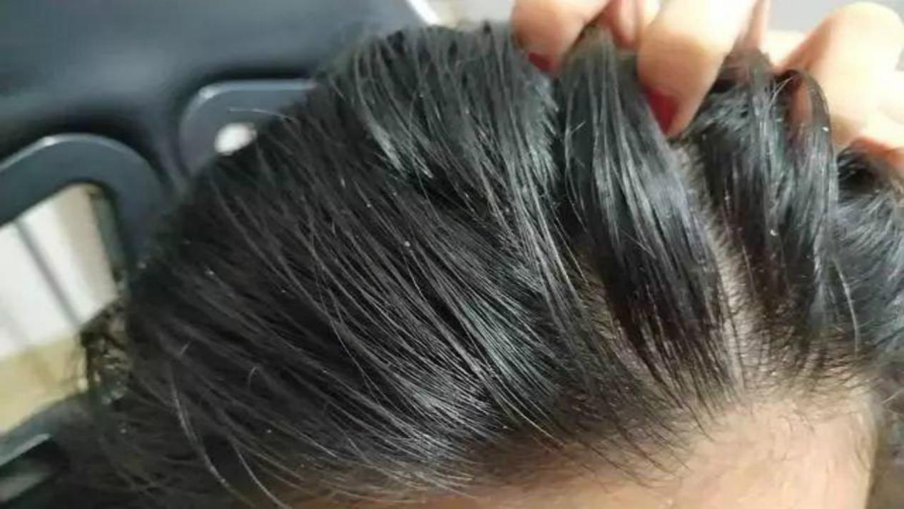 头皮屑反反复复发作怎么办,头皮屑反复发作是什么原因