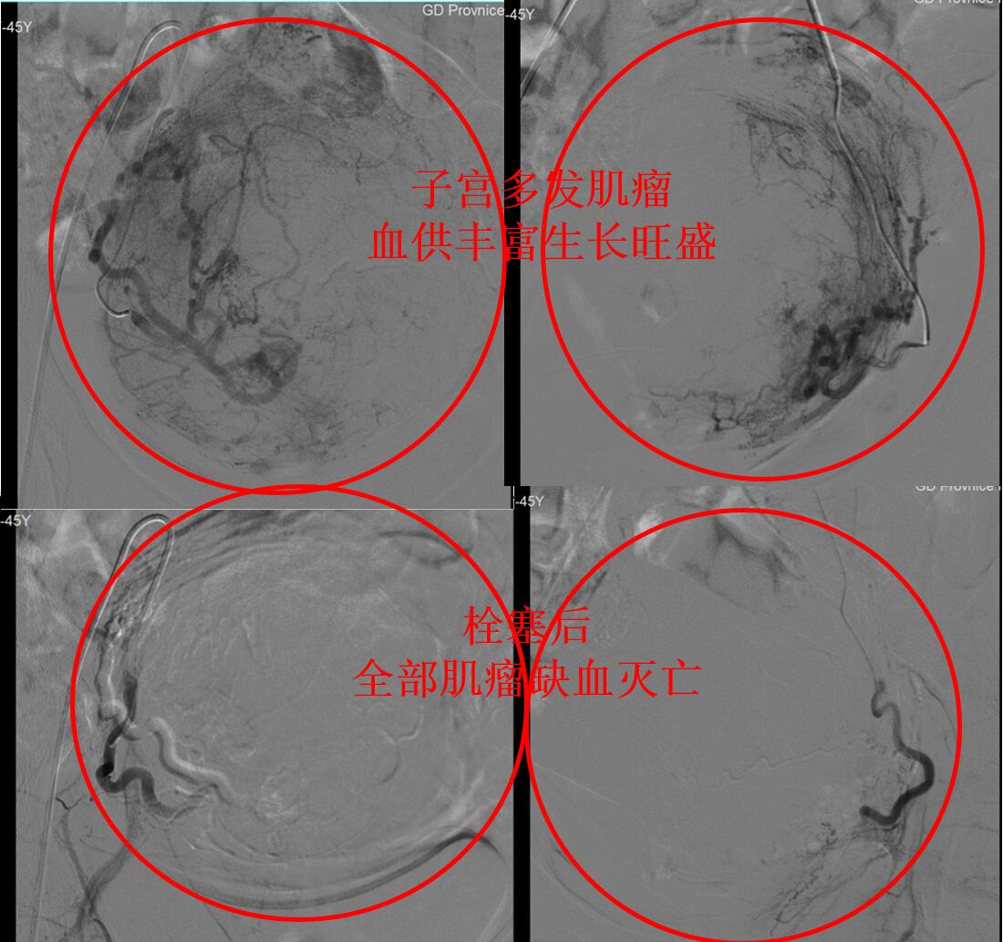 子宫肌瘤微创后月经量大有血块,严重贫血子宫肌瘤手术风险大不大