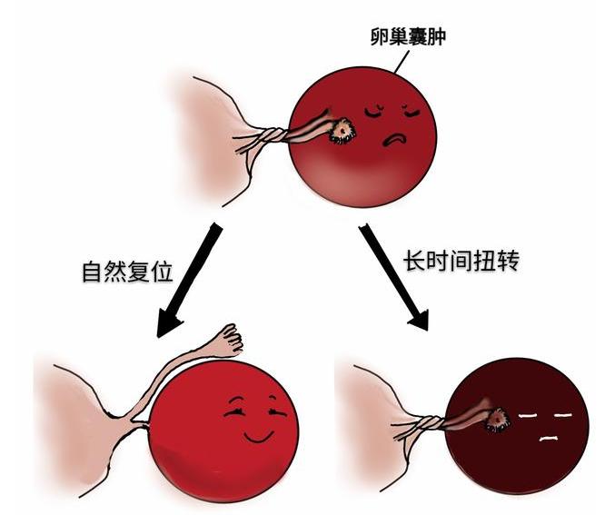 孕晚期突发腹痛：当心卵巢肿瘤扭转