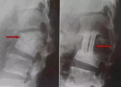 脊柱结核是怎么回事,健康科普不该被忽视的脊柱结核