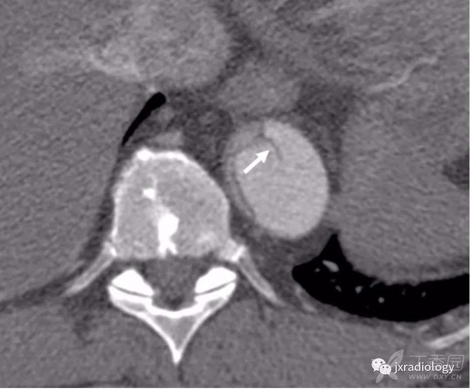 急性主动脉综合征报道,急性主动脉综合征症状